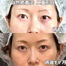 【女性・目元】自然癒着法二重形成_before_aftar