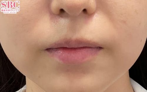 【女性・口角】口角挙上_before