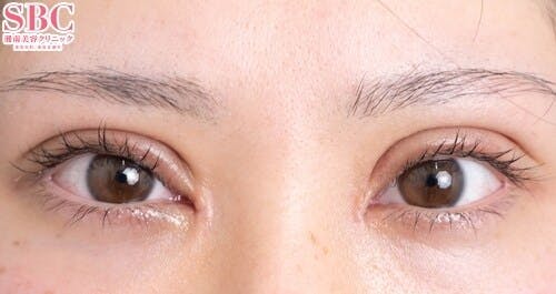 【10代女性・目元】眼瞼下垂＋二重_1week