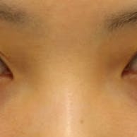 【女性・目元】クイックコスメティーク・ダブルNeo、SBC『デカ目』術_before