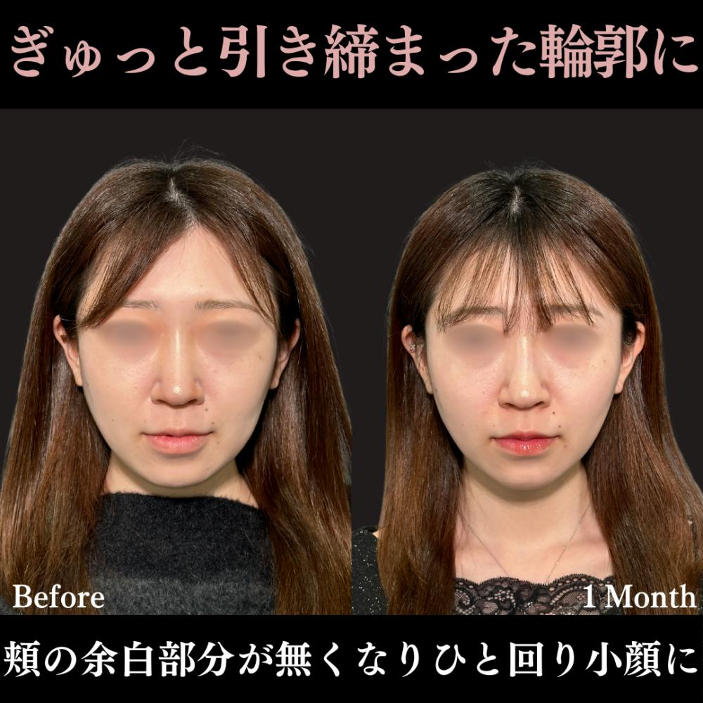 【20代女性・顔】PRISMリフト ＋ ヒアルロン酸注射（顎）_before_aftar