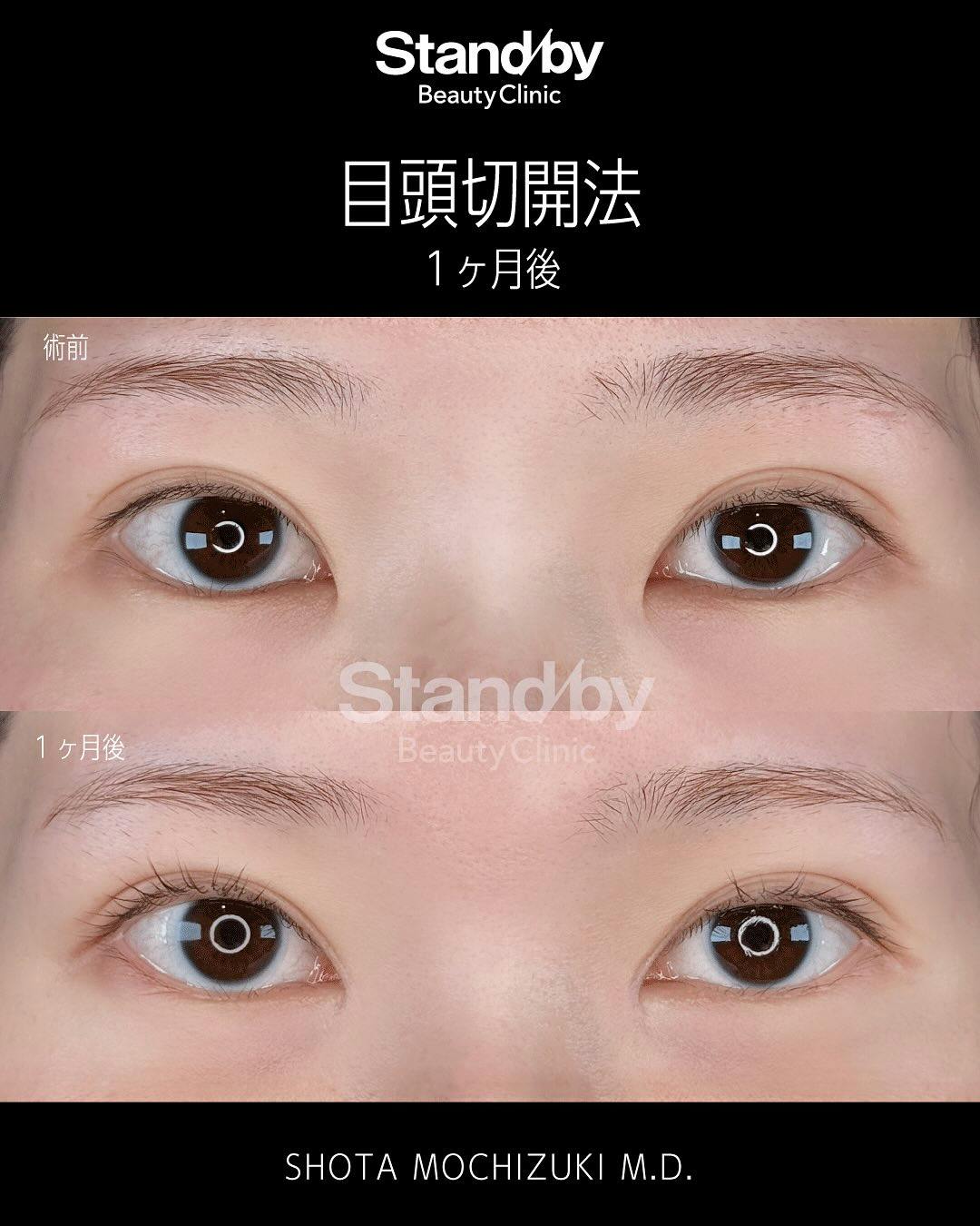 【女性・目元】目頭切開_before_aftar