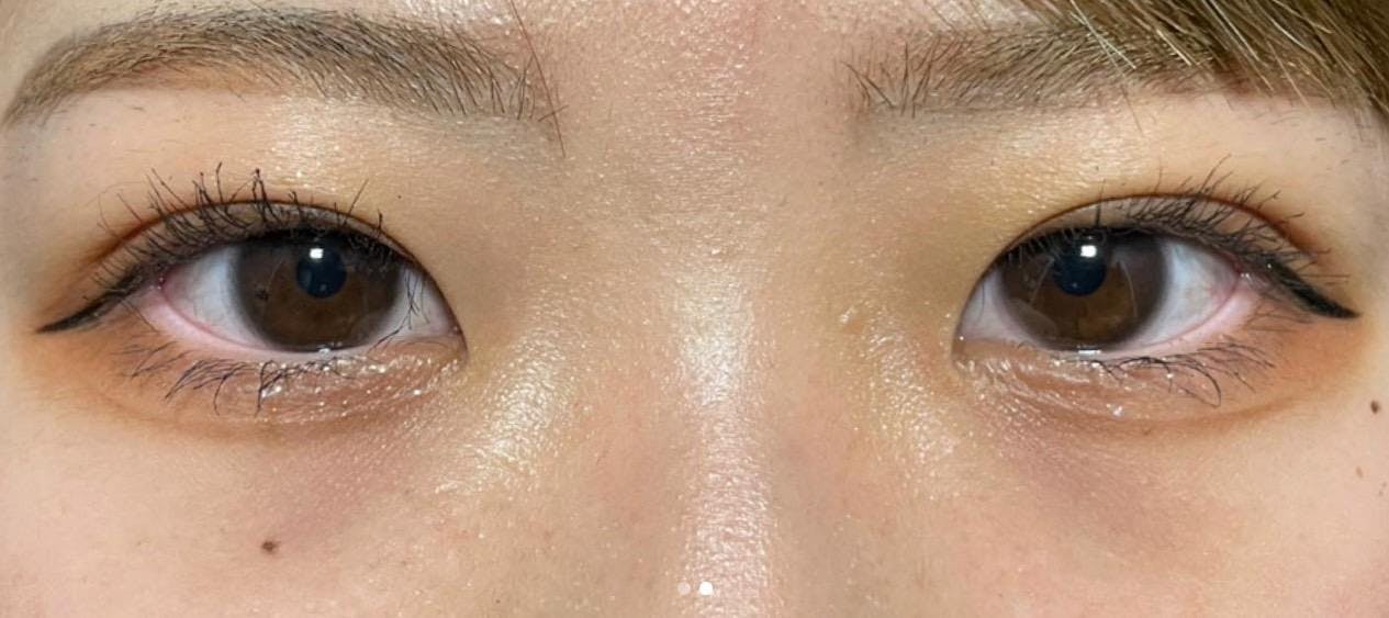 共立美容外科 渋谷院で切らない二重整形：埋没法「共立式二重P-PL挙筋法」を受けた橋本さんの写真