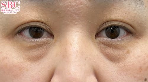 【女性・クマ】目の下の切らないクマ・たるみ（ふくらみ）取り ナチュラル脂肪注射コンデンスリッチ ナチュラル脂肪注射ナノリッチ_before