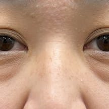 【女性・クマ】目の下の切らないクマ・たるみ(ふくらみ)取り ナチュラル脂肪注射コンデンスリッチ ナチュラル脂肪注射ナノリッチ_before