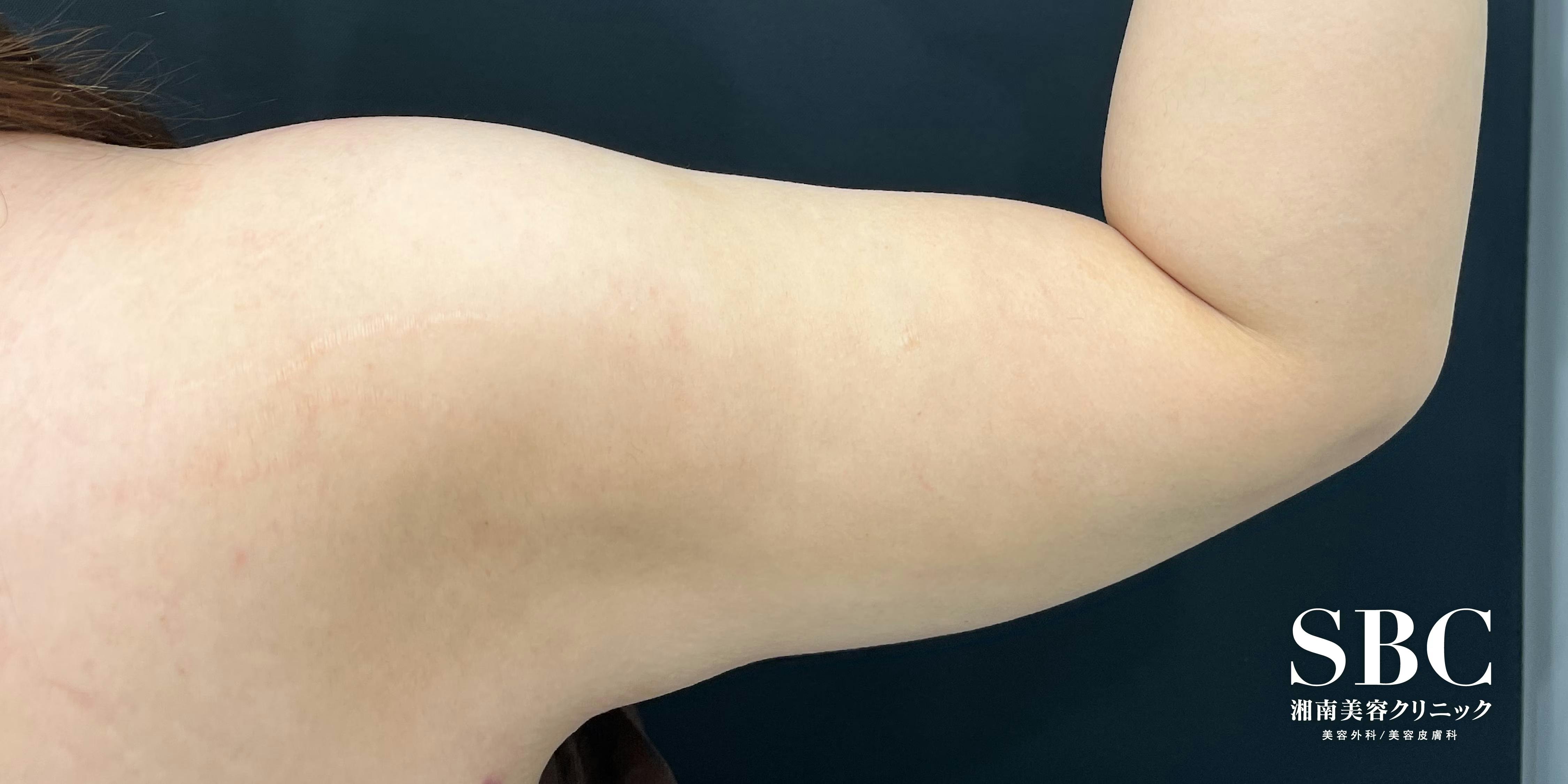 【女性・上半身・二の腕】Aquicell（アキーセル）脂肪吸引_aftar