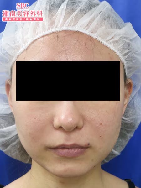 【女性・顔】根こそぎVASER脂肪吸引・ライポマティック脂肪吸引_before