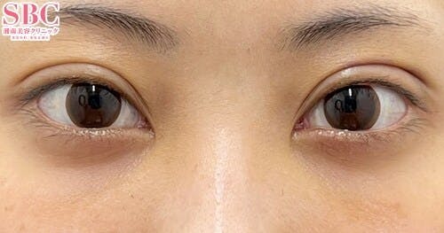 【20代女性・目元】目の下の切らないクマ・たるみ（ふくらみ）取り、ナチュラル脂肪注射コンデンスリッチ、ナチュラル脂肪注射ナノリッチ_1week