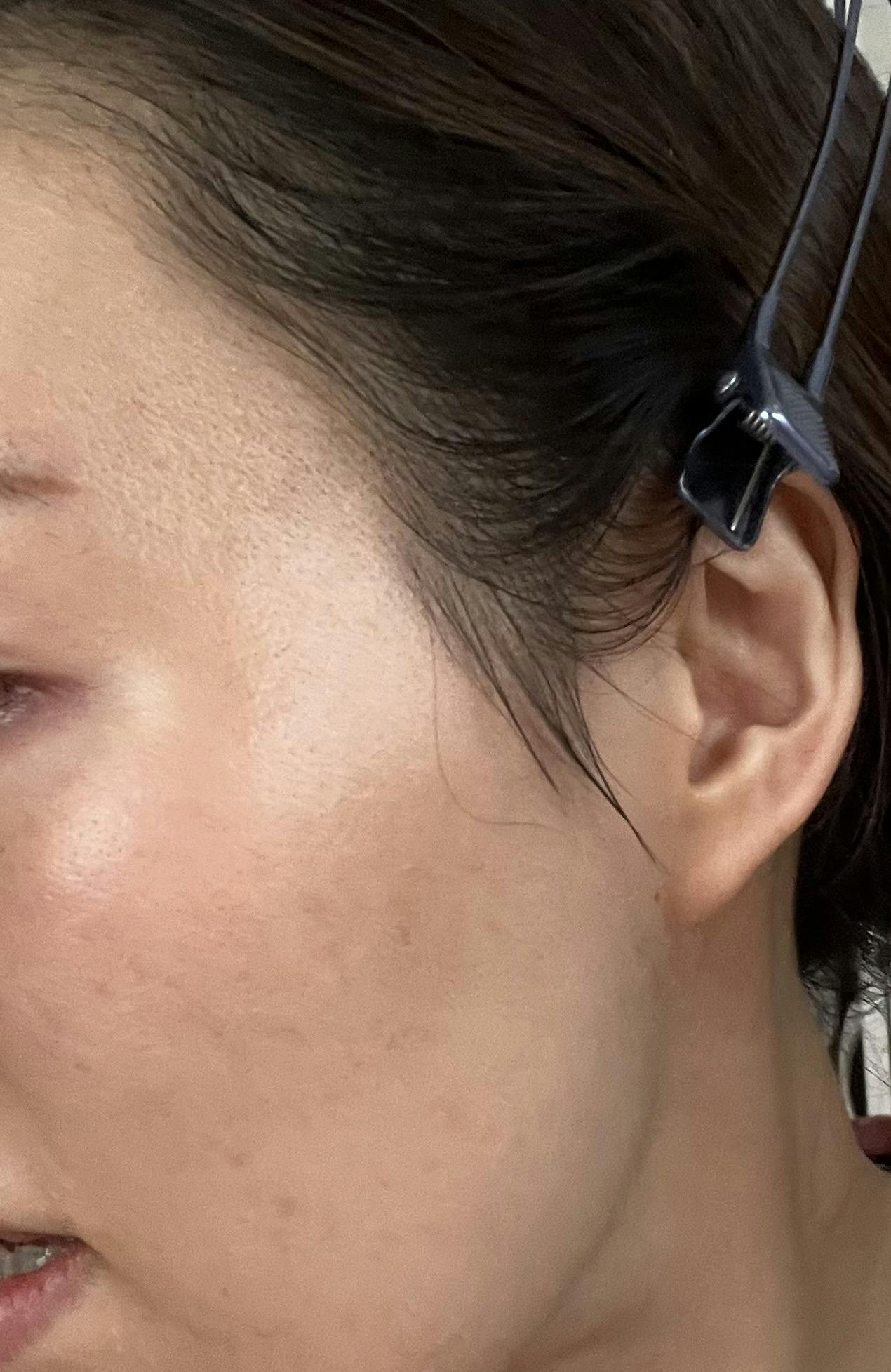 湘南美容クリニック 宇都宮院でフォトフェイシャルステラM22を受けたSaki9991さんの写真