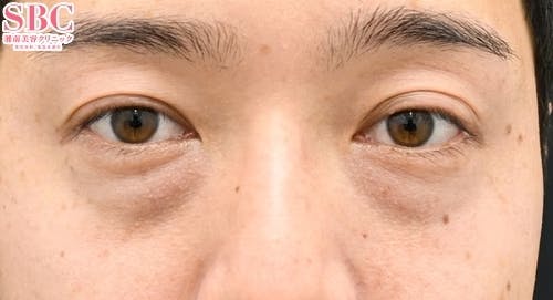 【目元】目の下の切らないクマ・たるみ（ふくらみ）取り、ナチュラル脂肪注射コンデンスリッチ_before