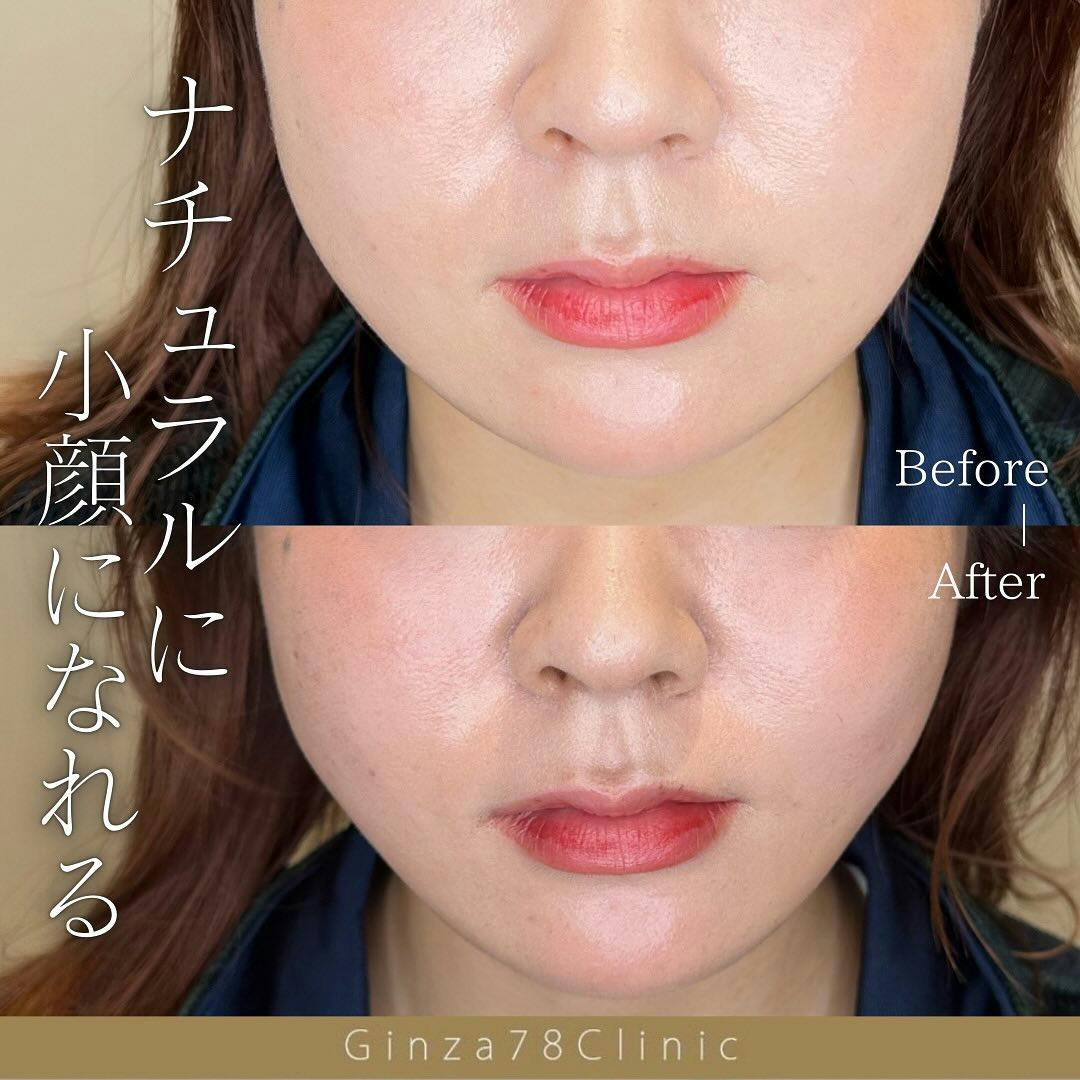 【女性・小顔】糸リフト_before_aftar