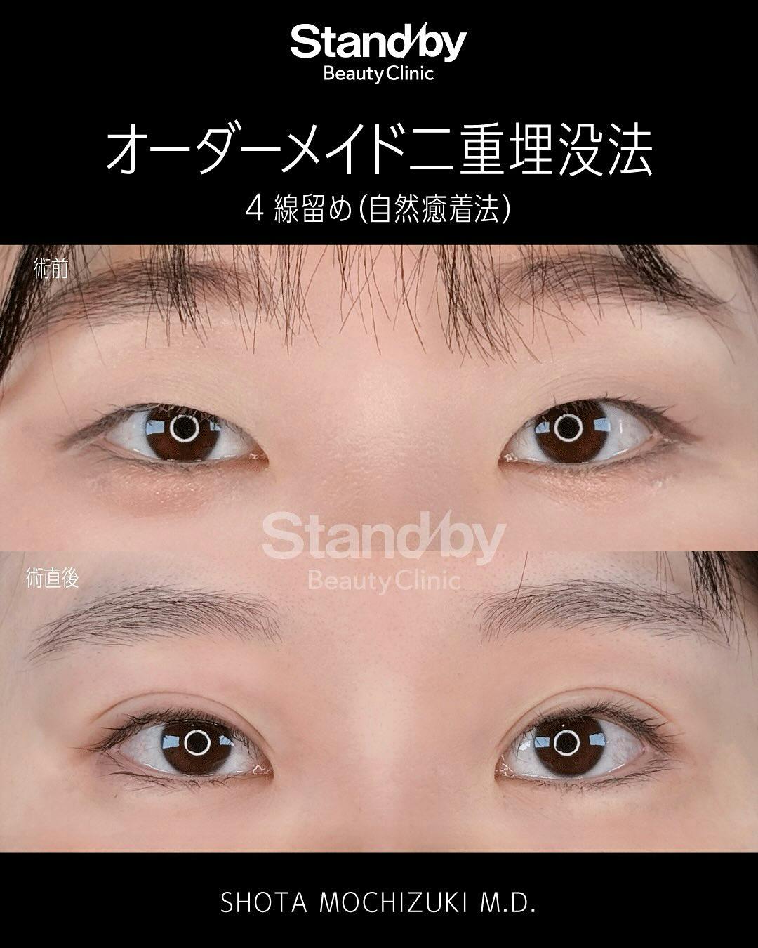 【女性・目元】オーダーメイド二重埋没法　4線留め(自然癒着法)_before_aftar