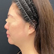 【40代女性・顔】根こそぎVASER脂肪吸引、ジョールファット除去術、あざむくみ抑制ドレナージュ、シークレットリフト、VOVリフト_before