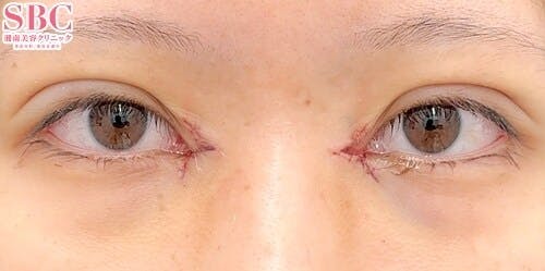 【女性・目元】クイックコスメティーク・ダブルNeo、目頭切開プレミアム、自然癒着セット（上眼瞼脱脂）_justafter