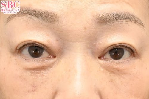 【60代・たるみ】目の下の切らないクマ・たるみ（ふくらみ）取り ナチュラル脂肪注射_after