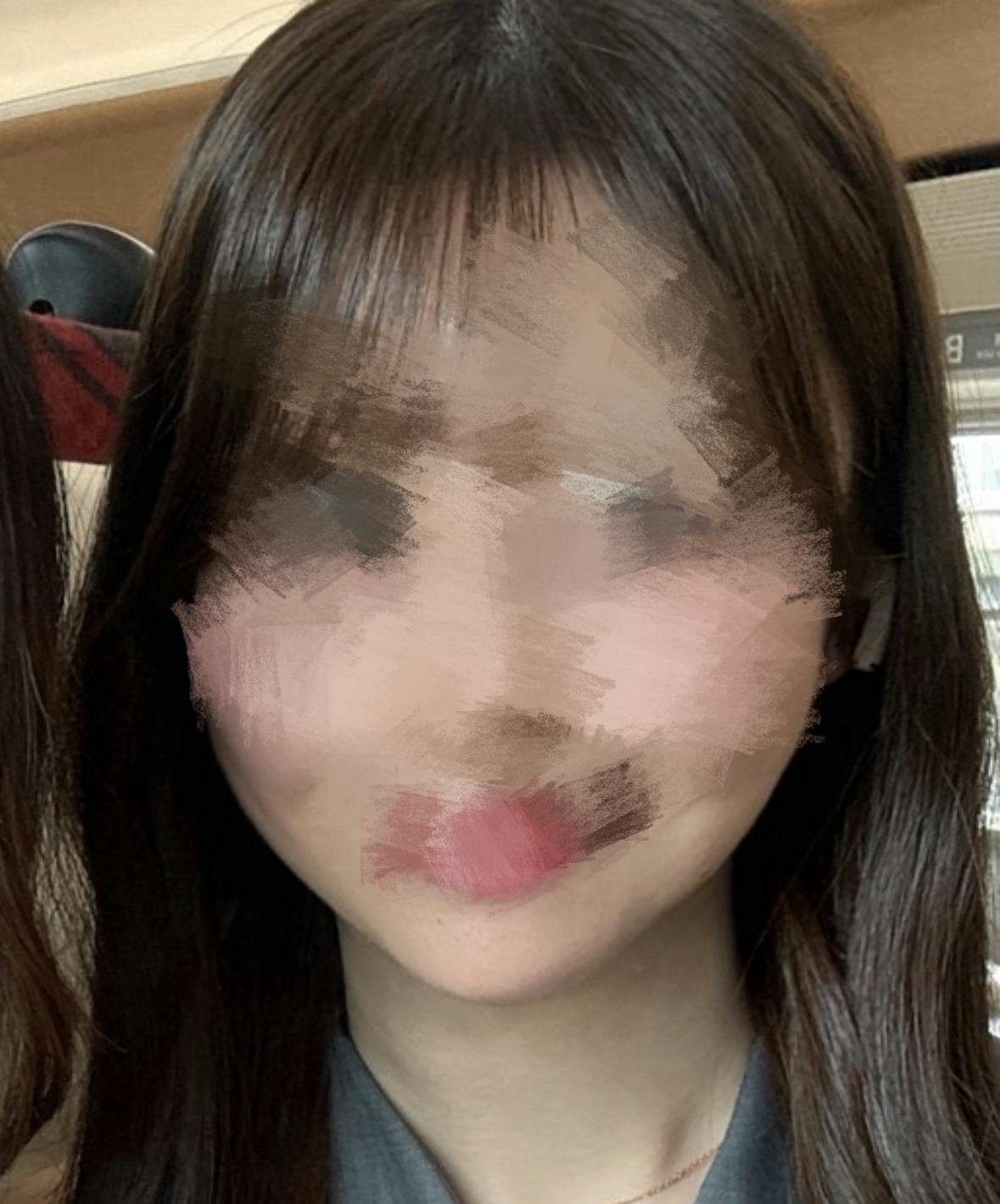 ティアムクリニック銀座(TIAM CLINIC GINZA)でインモードFX(頬・顎下)を受けたすてらさんの写真