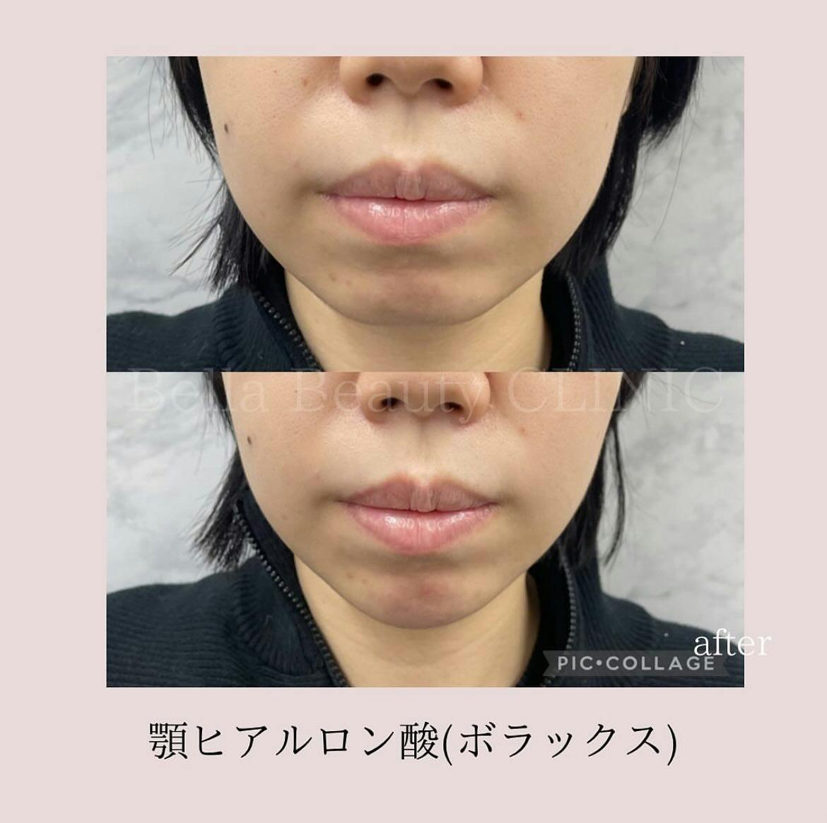 【女性・輪郭】ヒアルロン酸（顎）_before_aftar