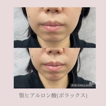 【女性・輪郭】ヒアルロン酸(顎)_before_aftar