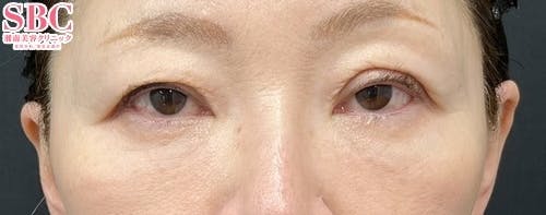 【50代女性・目元】ナチュラル脂肪注射コンデンスリッチ、ナチュラル脂肪注射ナノリッチ、目の下の切らないクマ・たるみ（ふくらみ）取り_after