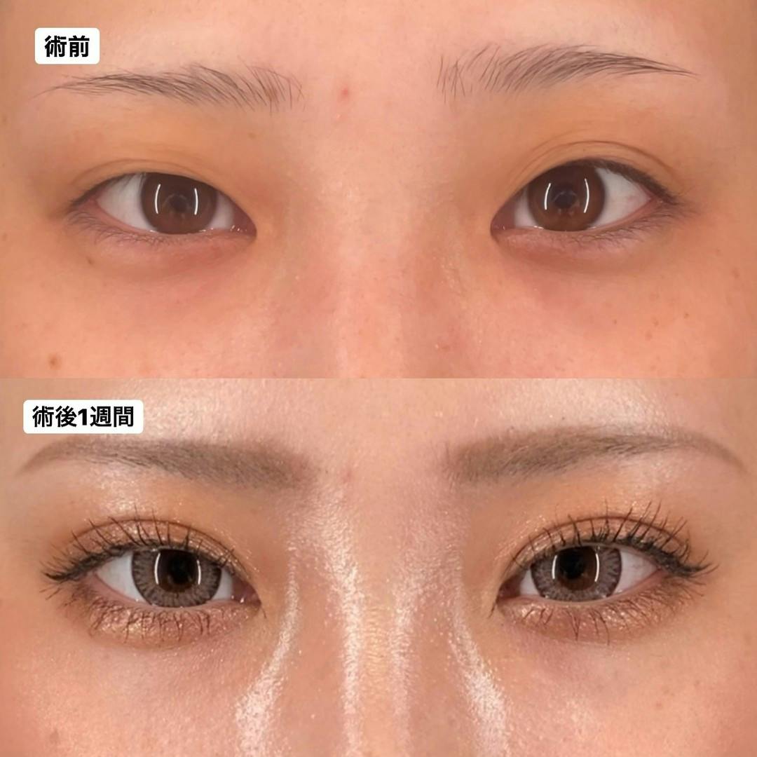 【女性・目元】Xクロスダブル_before_aftar