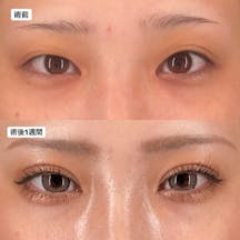 【女性・目元】Xクロスダブル_before_aftar
