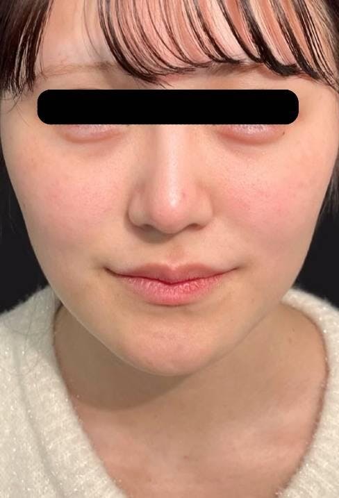 聖心美容クリニック 銀座院でフェイスリフト：顔脂肪吸引＋糸リフトを受けたはじもさんの写真