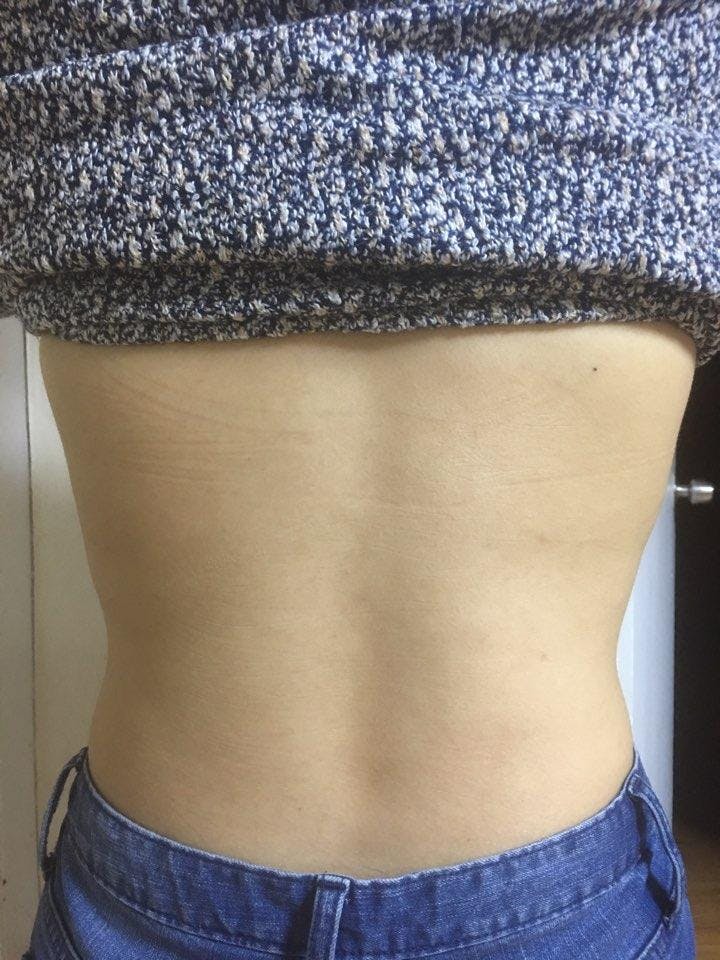 THE CLINIC（ザ・クリニック）大阪院でおなか回り脂肪吸引：脂肪吸引を受けたのりさんの写真