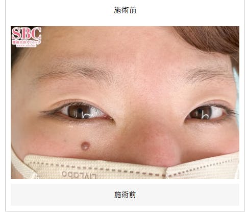 【女性・眉】眉毛_before