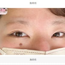 【女性・眉】眉毛_before