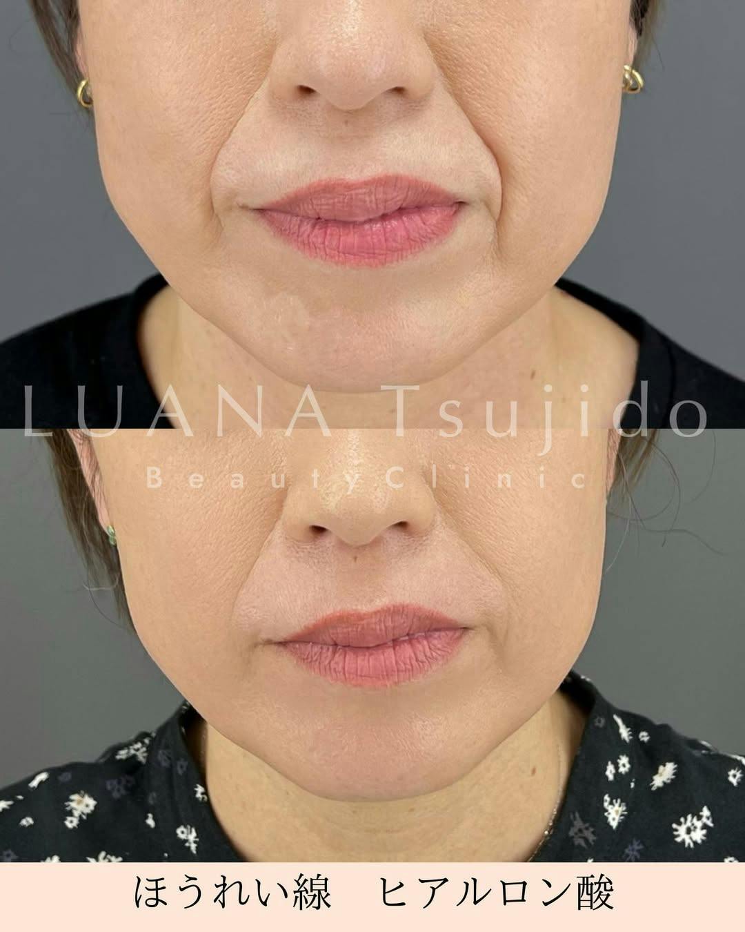 【女性・ほうれい線】ヒアルロン酸_before_aftar