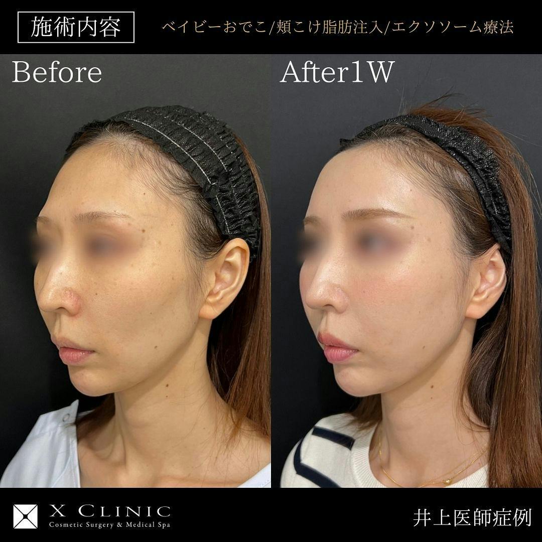 【女性・輪郭】ベイビーおでこ 頬こけ脂肪注入 エクソソーム_before_aftar
