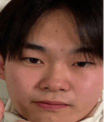 品川美容外科 名古屋院でほくろ・いぼ除去を受けたyossyさんの写真