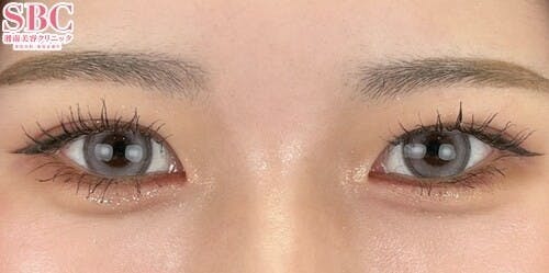 【10代女性・目元】クイックコスメティーク・ダブルNeo_after