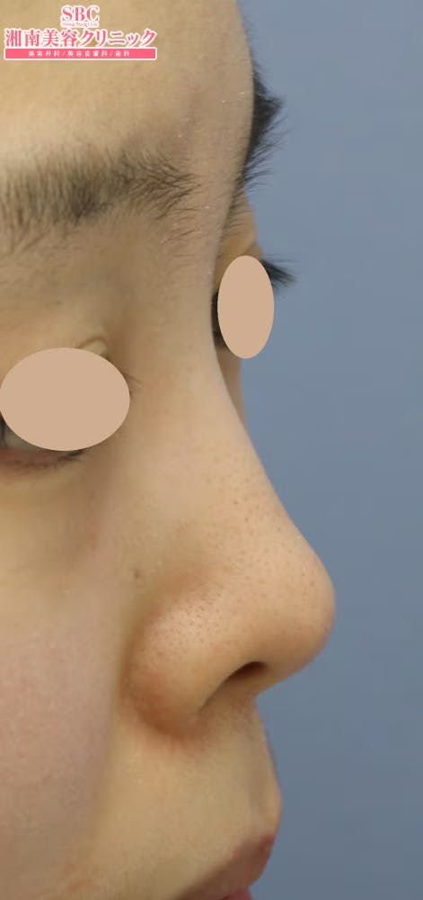 【女性・鼻】SBCプレミアムソフトプロテーゼ_before