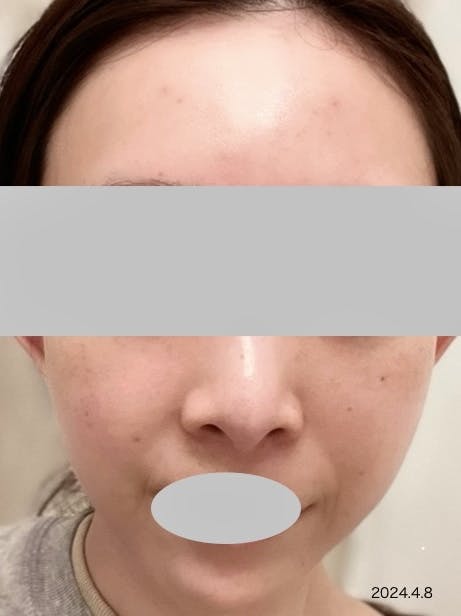 Casa de GRACIA GINZA(カサ・デ・グラシア銀座)でマッサージピール(コラーゲンピール)を受けたarai03さんの写真