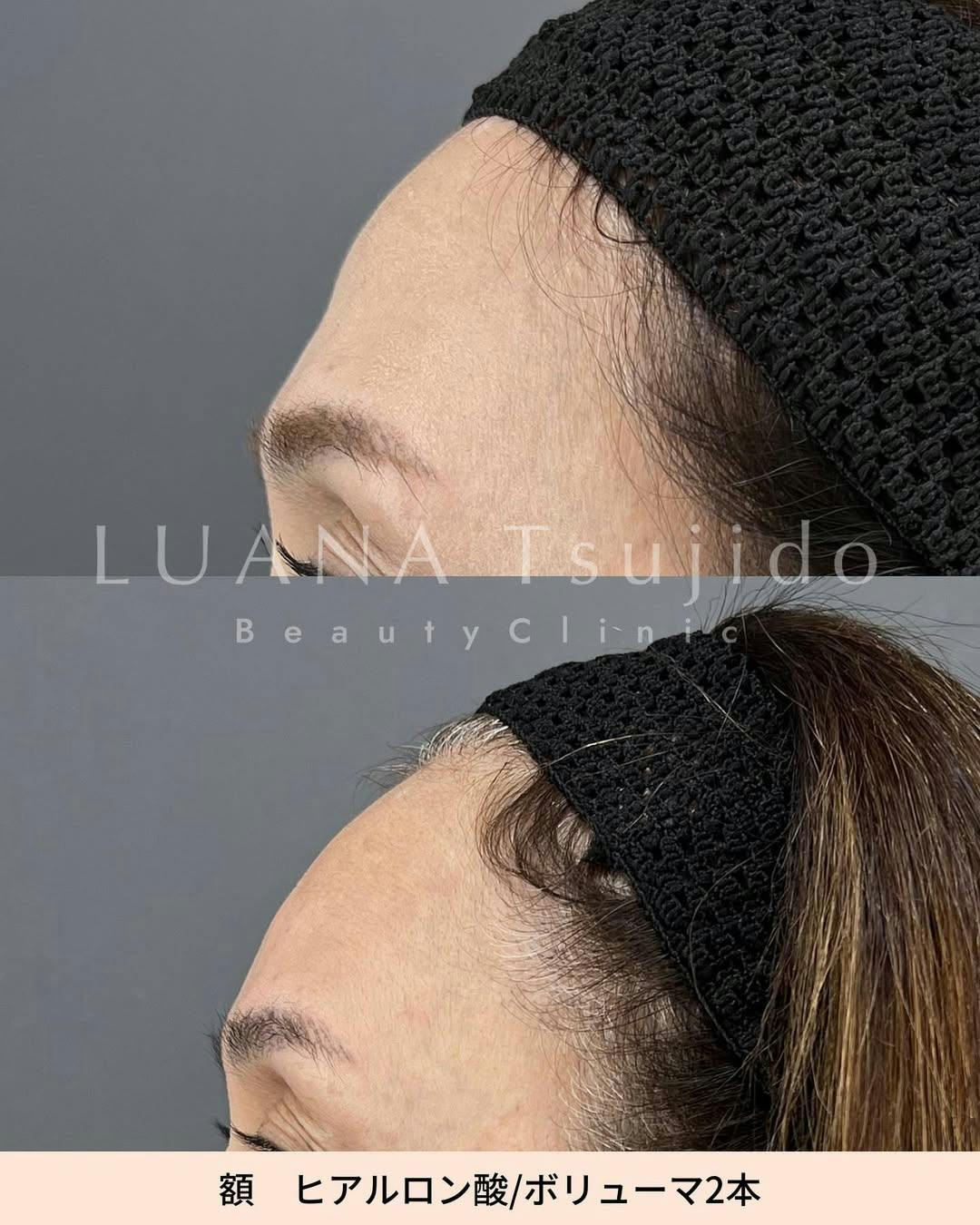 【女性・額】ヒアルロン酸_before_aftar