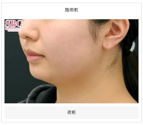 【女性・顔】根こそぎVASER脂肪吸引_before