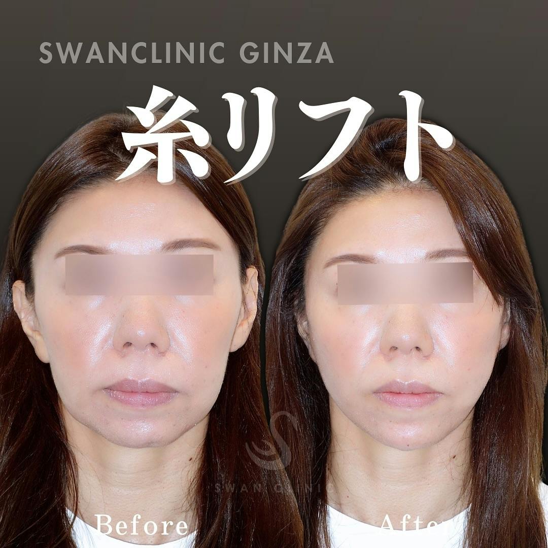 【女性・口元】糸リフト_before_aftar