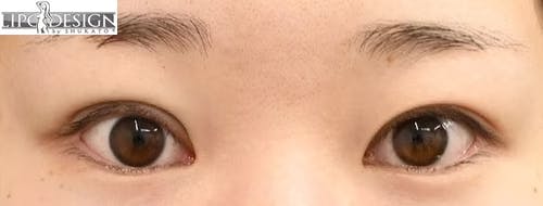 【22歳女性・目元】グランドループ法_justafter