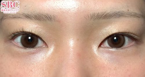 【20代女性・目元】線留めクロス二重術_before