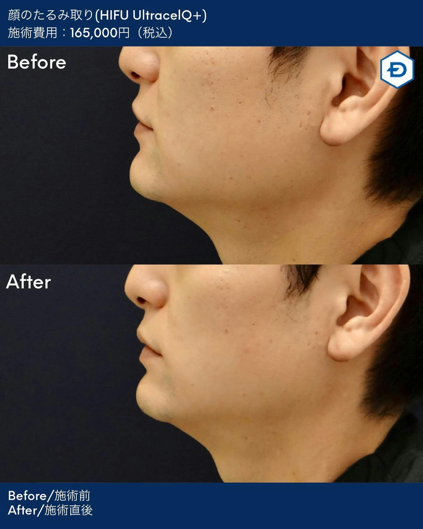 【男性・たるみ】顔のたるみ取り(HIFU UltracelQ+)_before_aftar