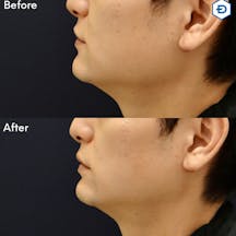 【男性・たるみ】顔のたるみ取り(HIFU UltracelQ+)_before_aftar