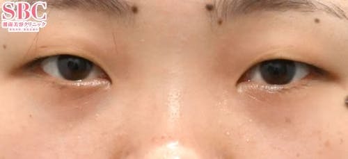 【女性・目元】クイックコスメティーク・ダブルNeo 自然癒着セット（上眼瞼脱脂）_before