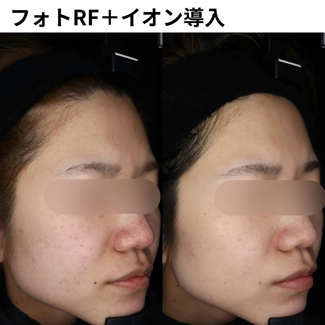 【女性・顔】フォトRF＋イオン導入（エンビロントリートメント）_before_aftar