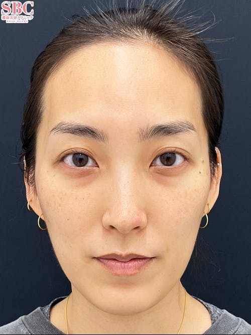 【女性・目元】裏ハムラ法 VOV（ボブ）リフト_before