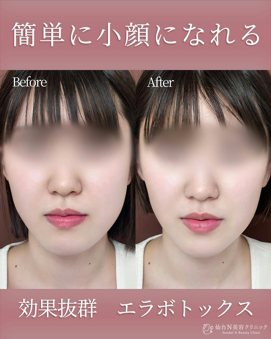【女性・小顔】エラボトックス_before_aftar