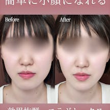 【女性・小顔】エラボトックス_before_aftar