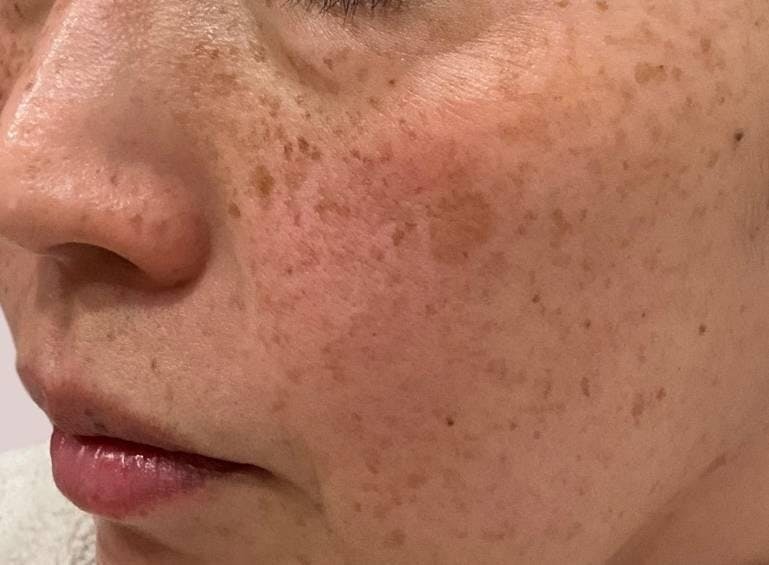 湘南美容クリニック 名古屋駅本院でシミレーザー ピコスポット:顔 シミ取り放題を受けた上尾みなみさんの写真