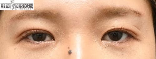 【33歳女性・目元】グランドループ法_after