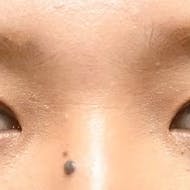 【33歳女性・目元】グランドループ法_after